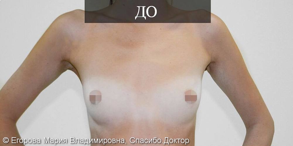 Эндоскопическое увеличение груди, фото до и после - фото №1
