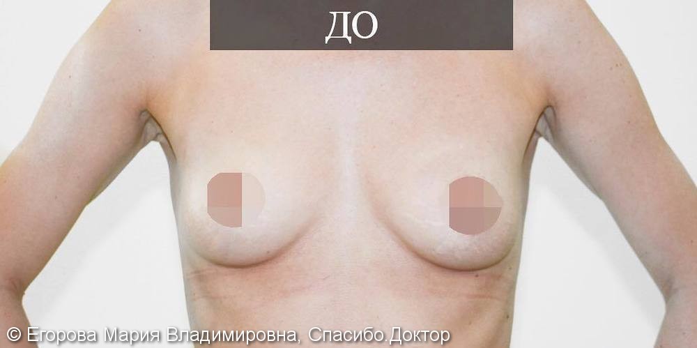 Результат увеличения груди и устранения асимметрии, фото до и после - фото №1