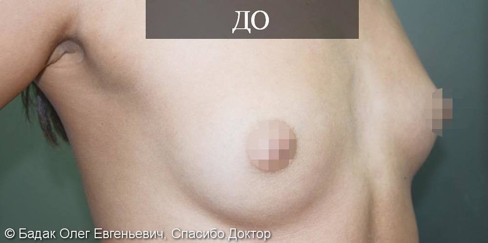 Эндоскопическое увеличение груди, фото до/после операции - фото №1