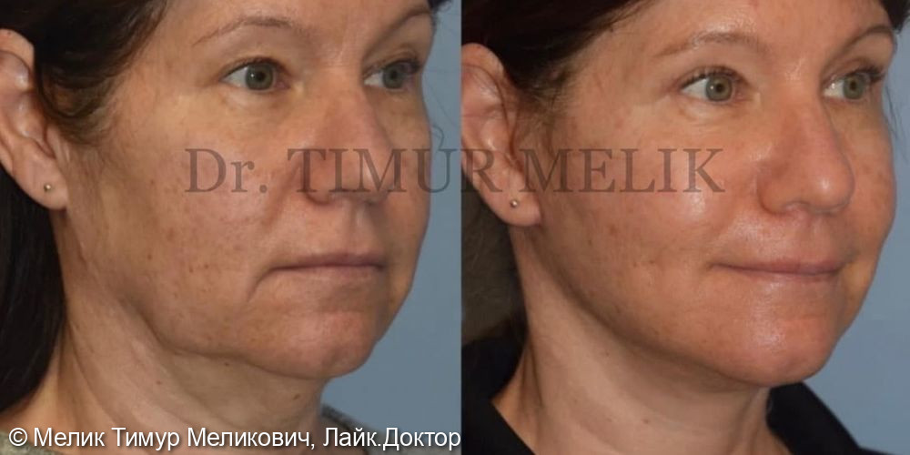 Подтяжка лица и подтяжка шеи, результат через 9 месяцев после операции - фото №1