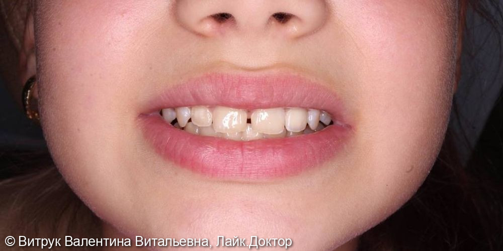 Восстановление зуба в зоне улыбке - фото №2