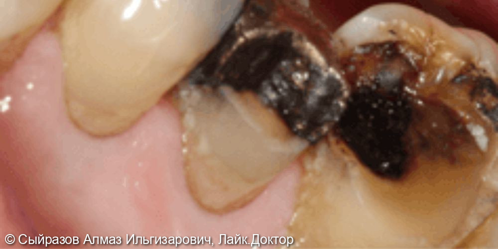 Протезирование коронками жевательных зубов - фото №1