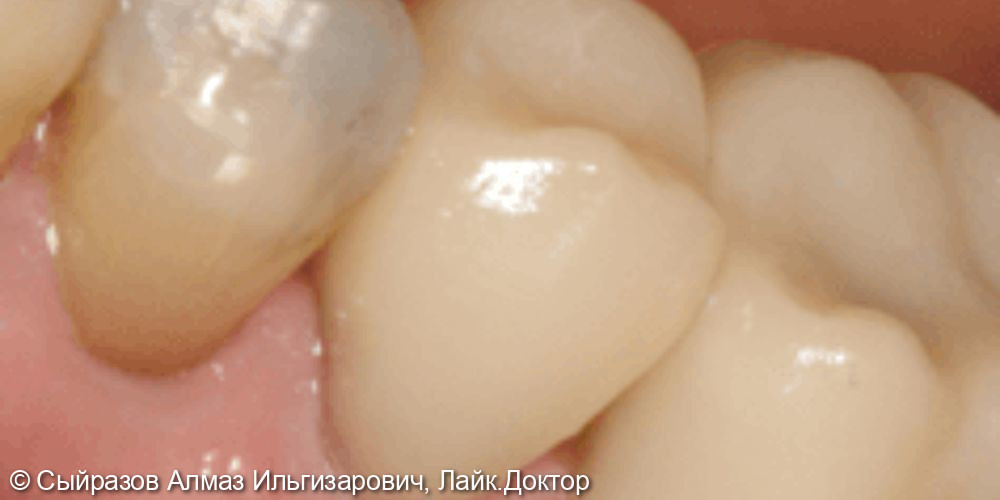 Протезирование коронками жевательных зубов - фото №2