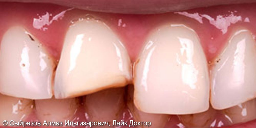 Эстетическое и функциональное восстановление передних зубов - фото №1