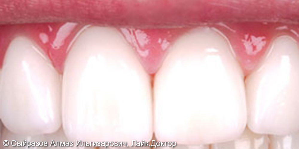 Эстетическое и функциональное восстановление передних зубов - фото №2