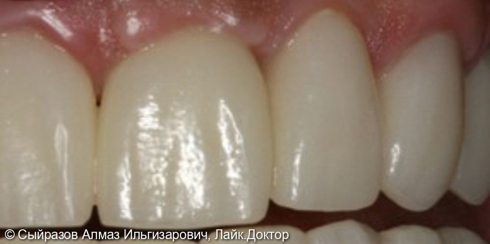 Восстановление разрушенного зуба - фото №2