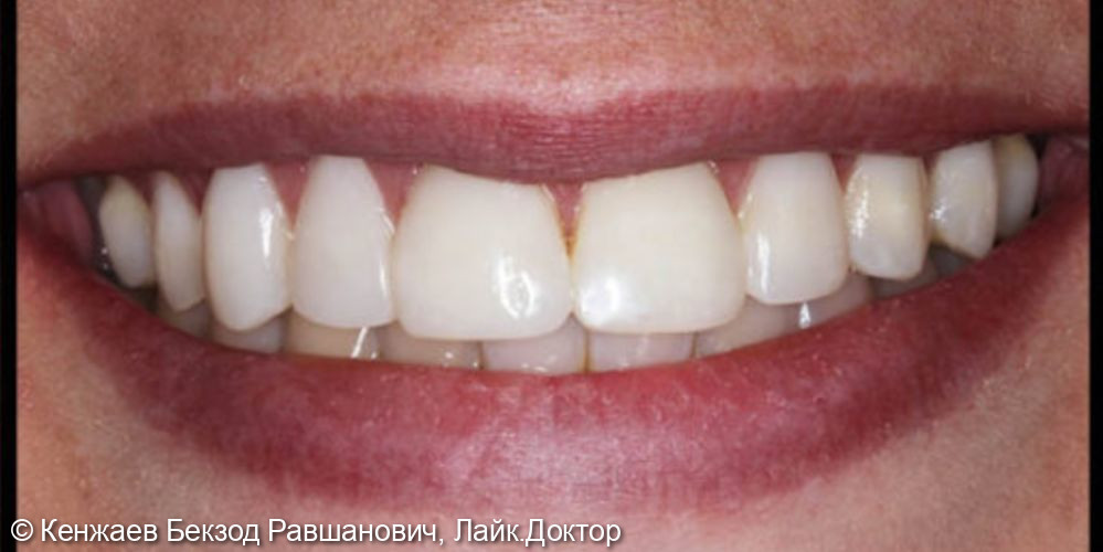 Лечение кариеса передних зубов - фото №2