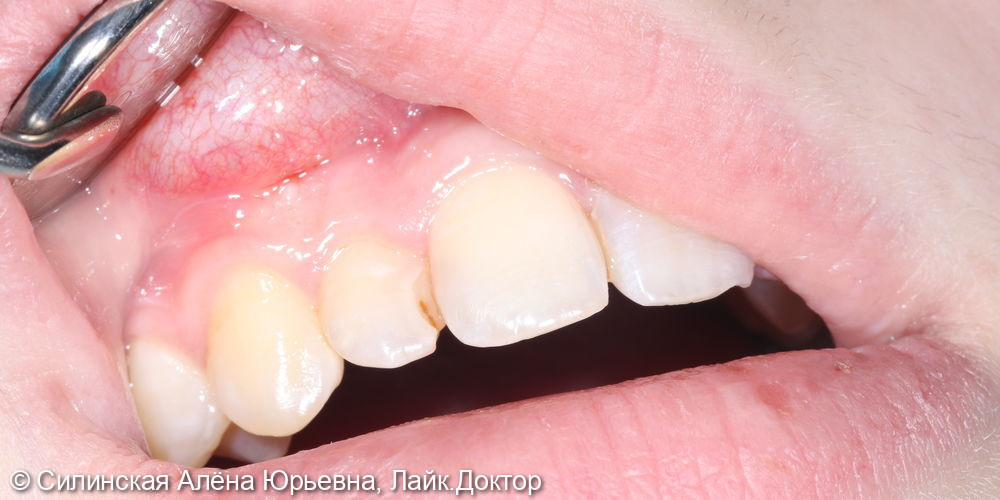 Лечение кариеса 12 зуба, замена несостоятельной реставрации - фото №1