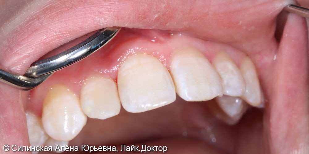Лечение кариеса 12 зуба, замена несостоятельной реставрации - фото №7