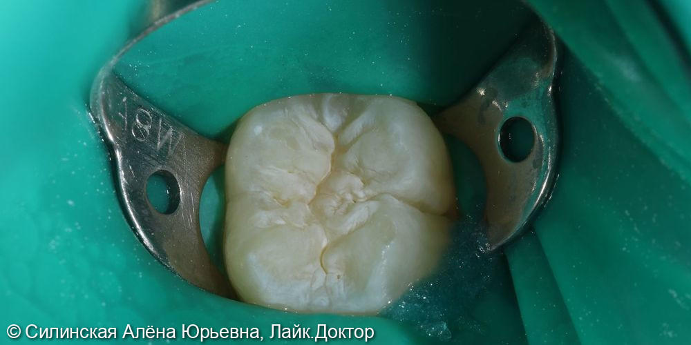 герметизация зуба 37 - фото №2