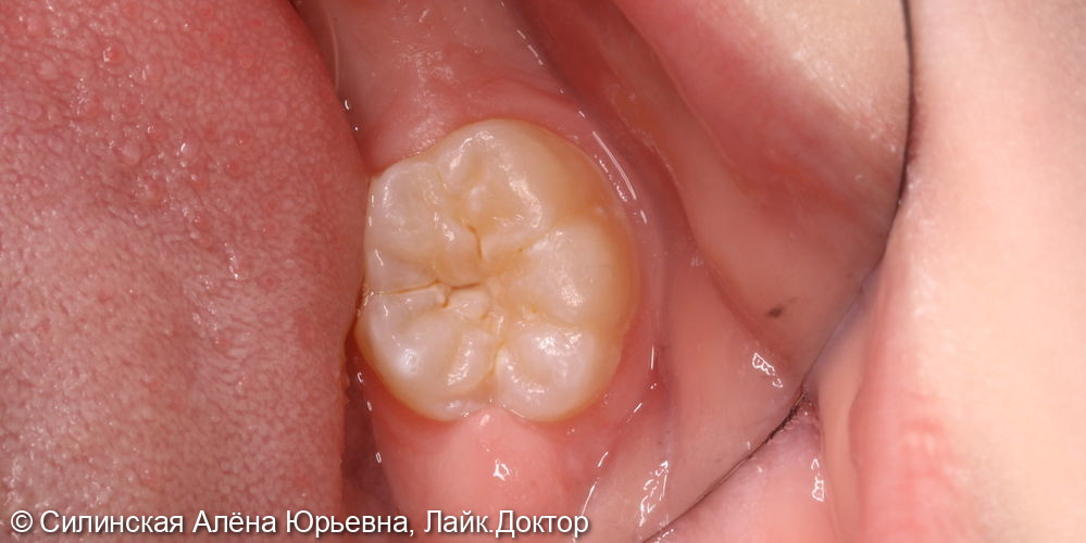 лечение кариеса зуба 46 - фото №1