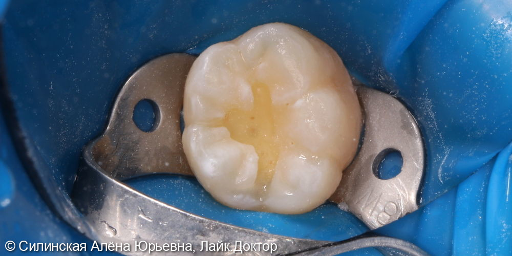 лечение кариеса зуба 46 - фото №4