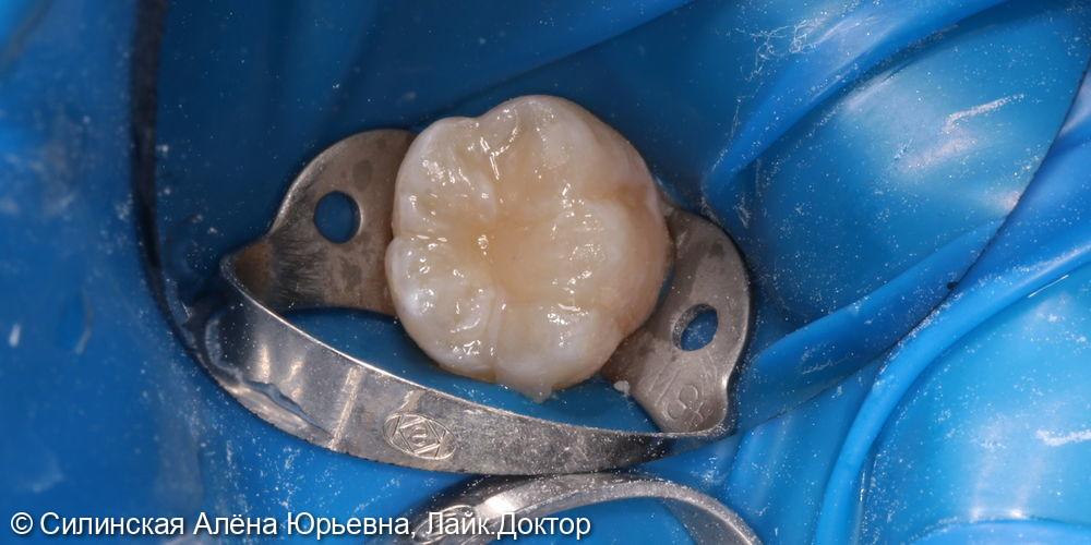 лечение кариеса зуба 46 - фото №5