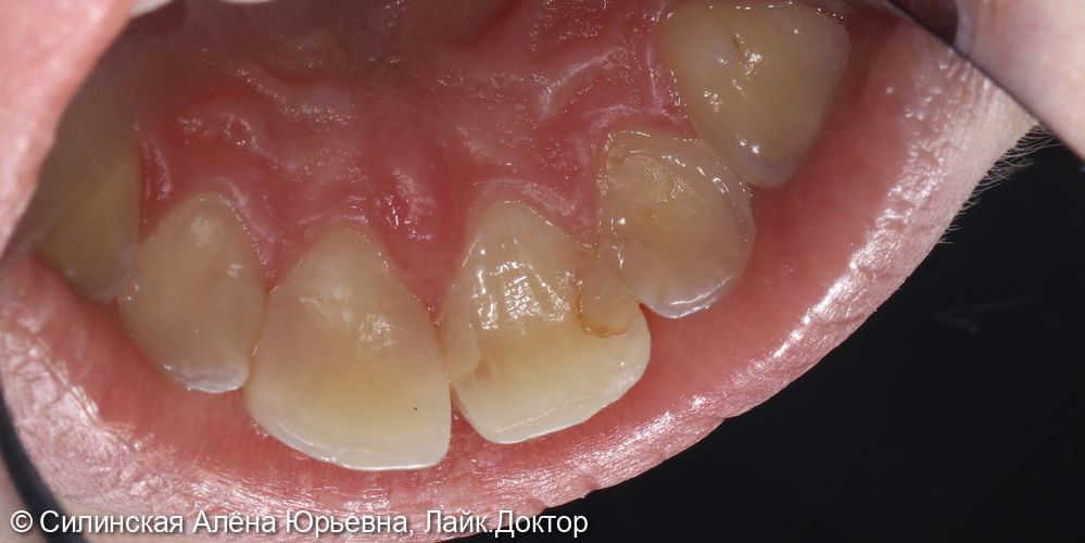 лечение кариеса 21 и 22 - фото №2