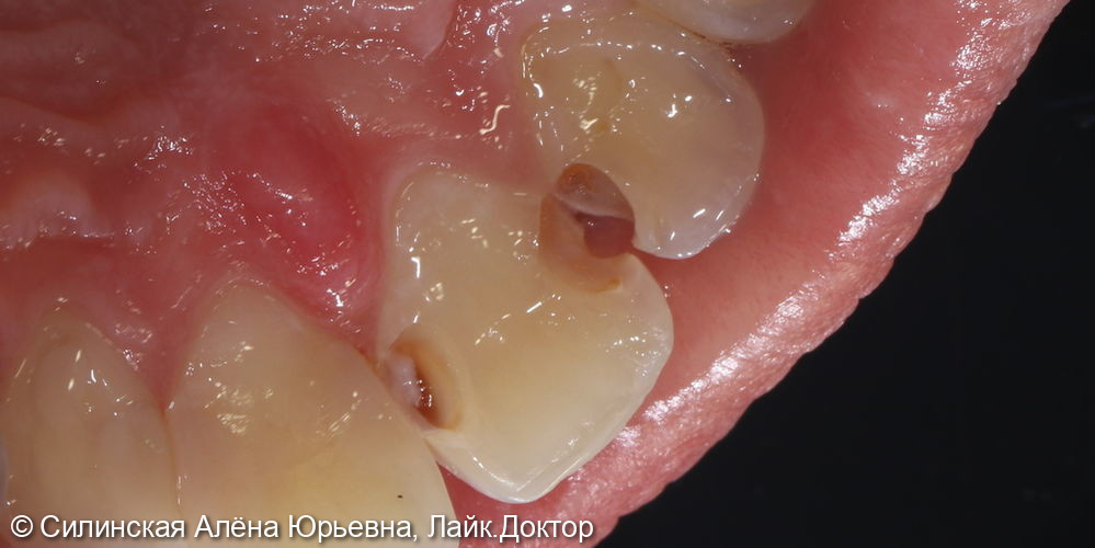 лечение кариеса 21 и 22 - фото №3