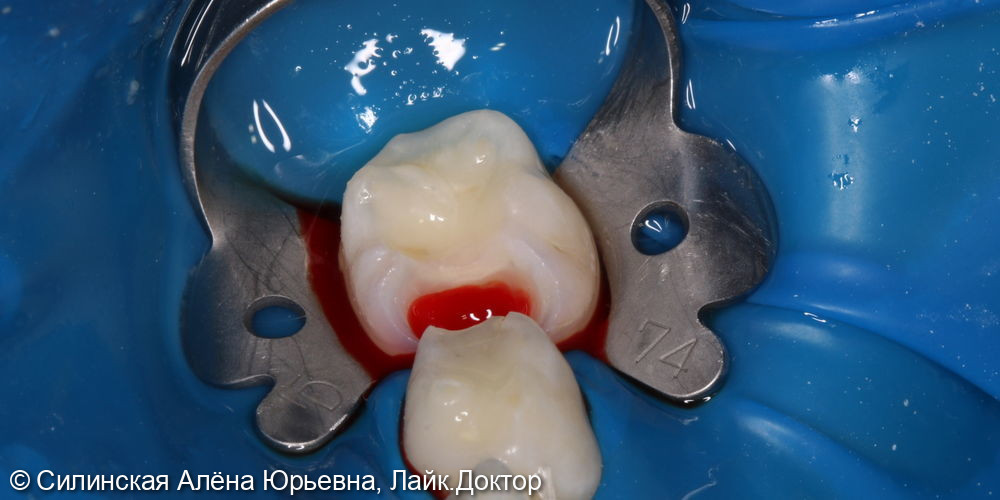 лечение необратимого пульпита молочного зуба 75 - фото №3