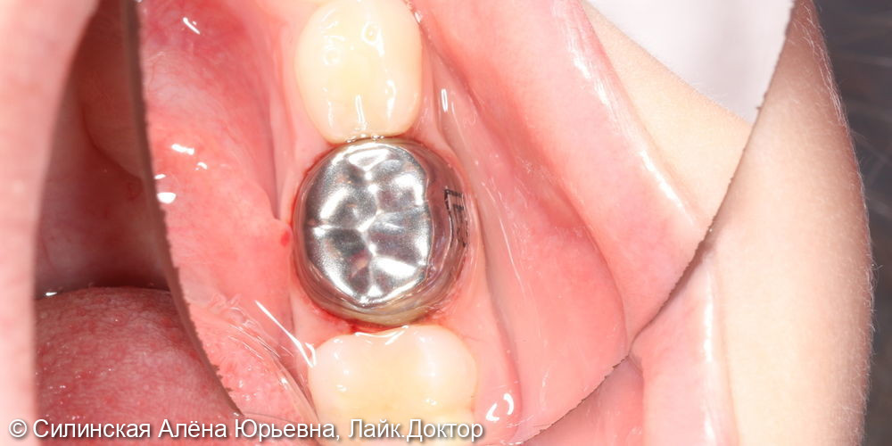 лечение необратимого пульпита молочного зуба 75 - фото №9