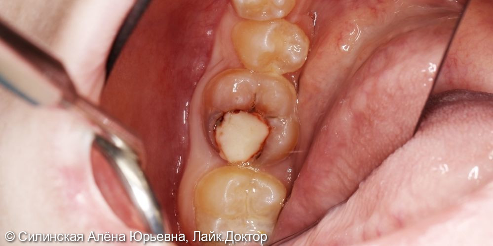 эндодонтическое лечение зуба 46 - фото №1