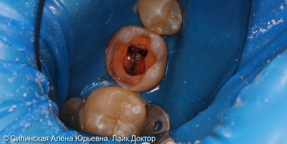 эндодонтическое лечение зуба 46 - фото №4