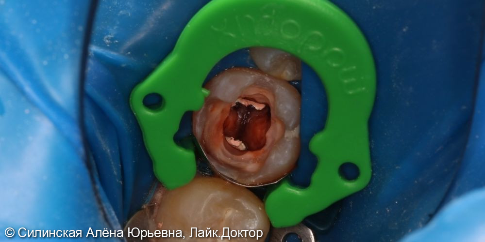 эндодонтическое лечение зуба 46 - фото №5
