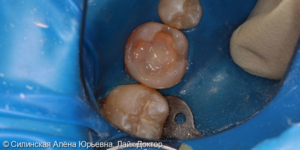 эндодонтическое лечение зуба 46 - фото №7