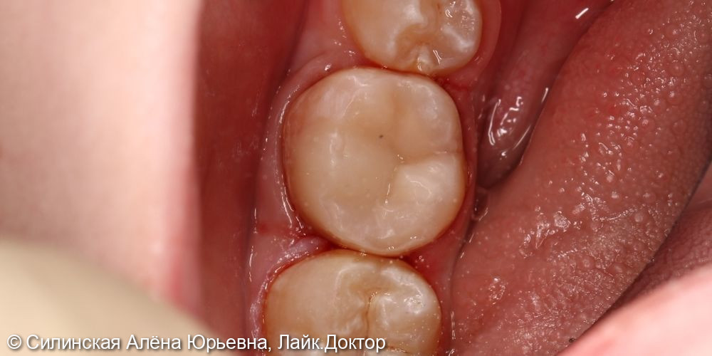 эндодонтическое лечение зуба 46 - фото №9