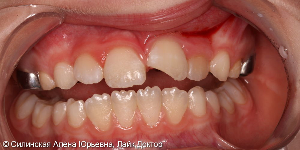 травма зуба 21 - фото №1