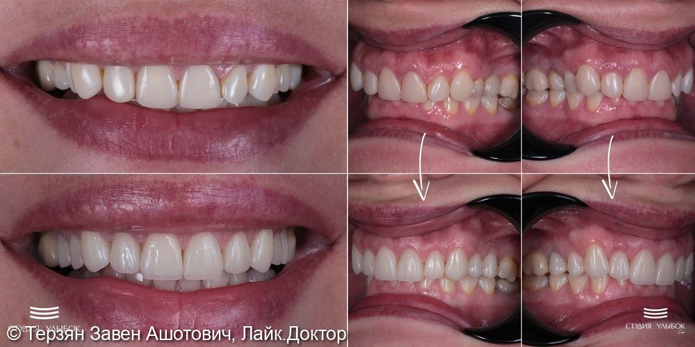 Установка керамических коронок и вниров EMax цвет В2 на свои зубы только верхней челюсти (15,14,13,12,11, 21,22,23,24 зубы) - фото №1