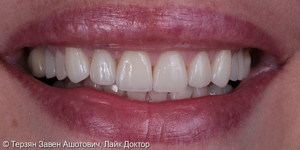 Установка керамических коронок и вниров EMax цвет В2 на свои зубы только верхней челюсти (15,14,13,12,11, 21,22,23,24 зубы) - фото №2