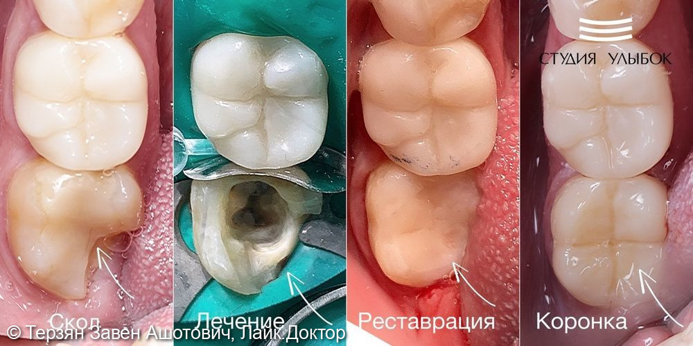 Закрытие зуба коронкой из диоксида циркония после скола и лечения каналов - фото №1