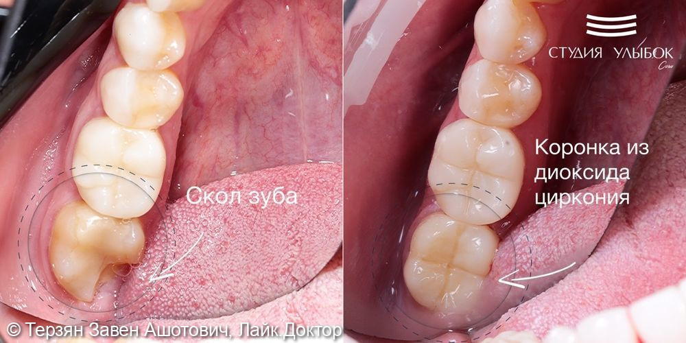 Закрытие зуба коронкой из диоксида циркония после скола и лечения каналов - фото №2