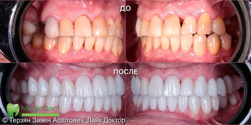 Комплексная работа по восстановлению функции и эстетики улыбки у пациента 30-ти лет фото 3 · Сочи
