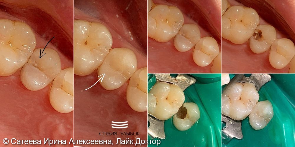 Лечение скрытого кариеса 25 зуба - фото №1