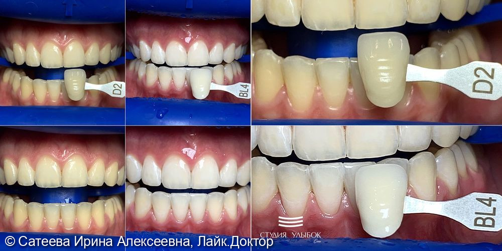 Клинический случай отбеливания зубов zoom-4 - фото №1