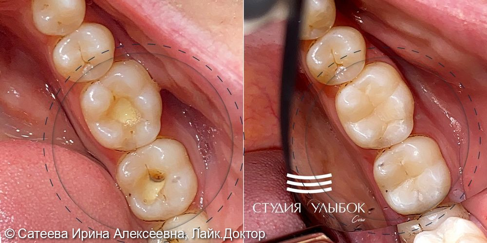 Замена старых реставраций 36, 37 зубов у пациента 46-ти лет. Кейс - фото №2