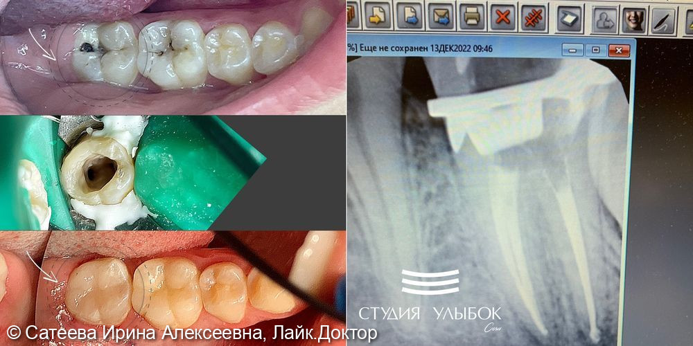 Лечение пульпита 37 зуба - фото №1
