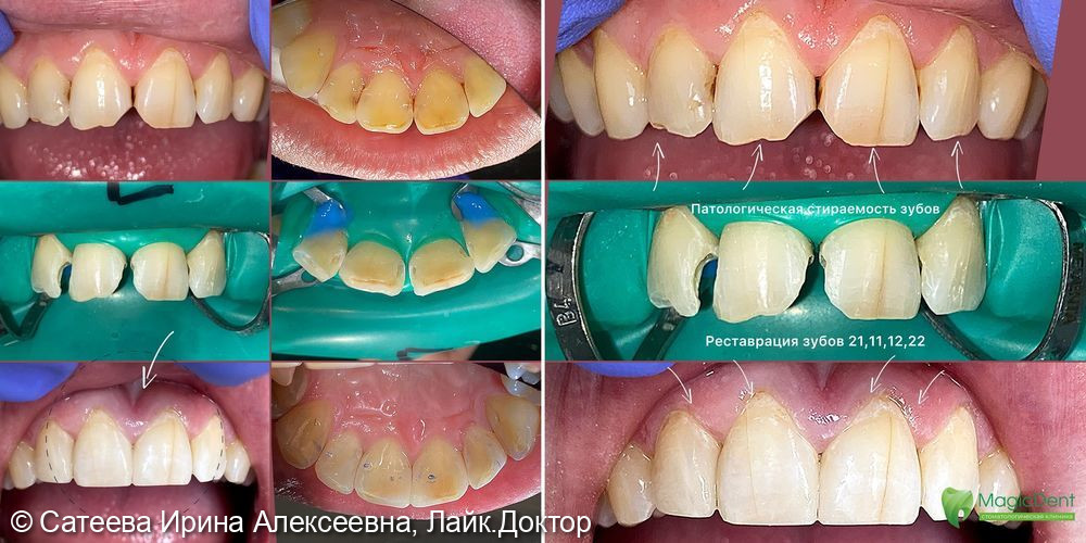 Лечение патологической стираемости твердых тканей зубов 12,11,21,22 резцов у пациента 36-ти лет - фото №2