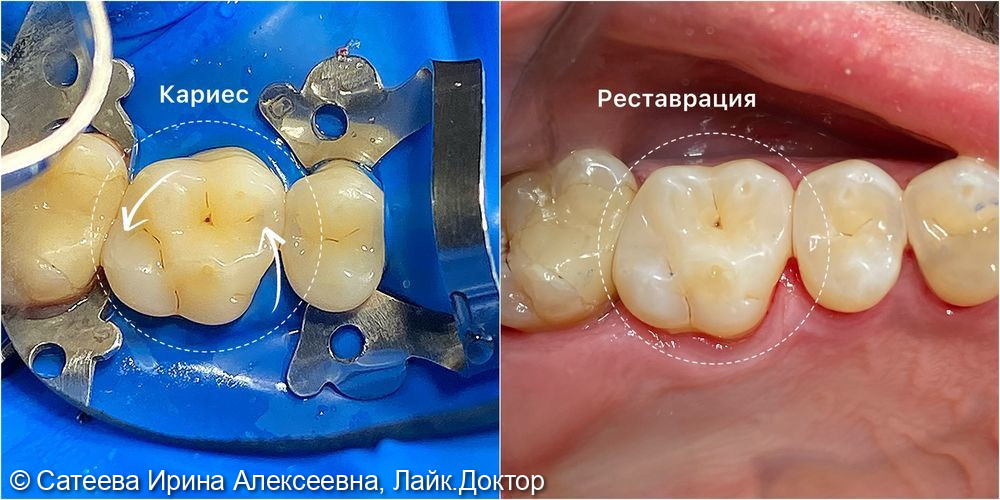 Лечение кариеса дентина зубов 25,26 - фото №2