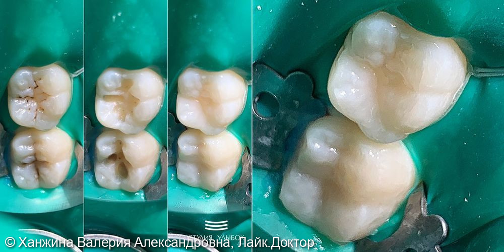 Кейс восстановления природной анатомии зубов после лечения кариеса дентина у подростка - фото №1