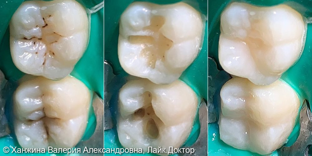 Кейс восстановления природной анатомии зубов после лечения кариеса дентина у подростка - фото №2