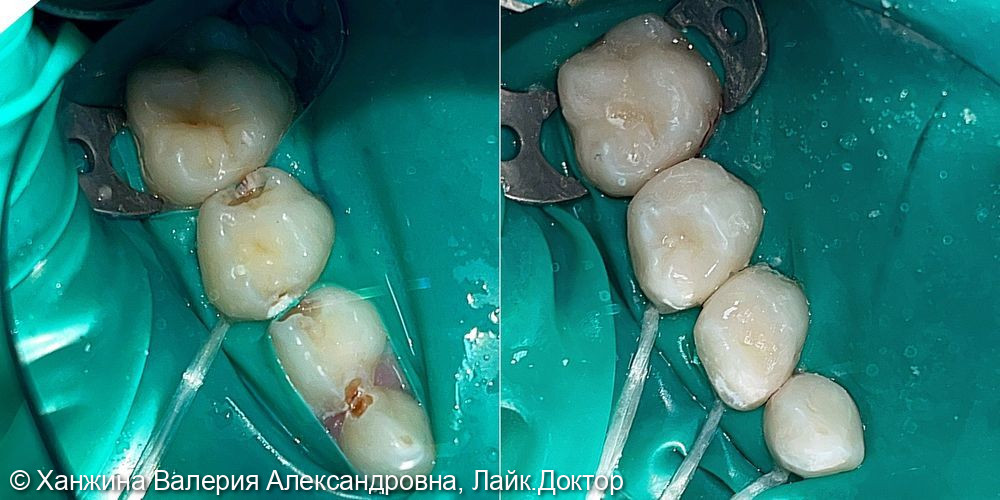 Лечение пульпита 16-го постоянного зуба и кариеса молочных зубов 53,54,55 - фото №1