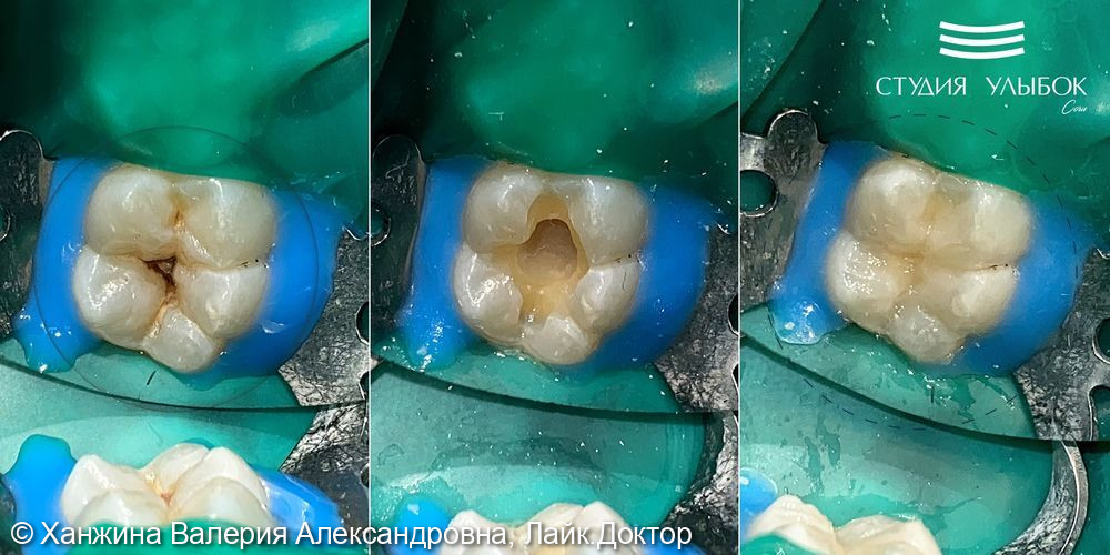 Лечение кариеса шестого зуба у подростка - фото №1