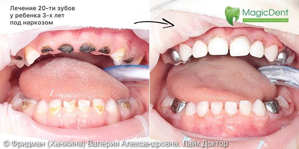 Лечение кариеса у ребенка 3-х лет под наркозом (20-ти зубов) - фото №1