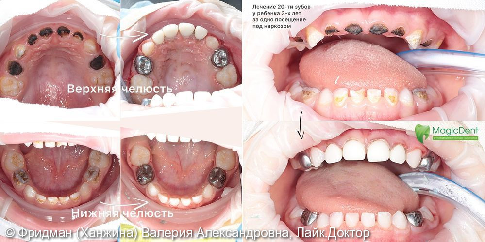 Лечение кариеса у ребенка 3-х лет под наркозом (20-ти зубов) - фото №3