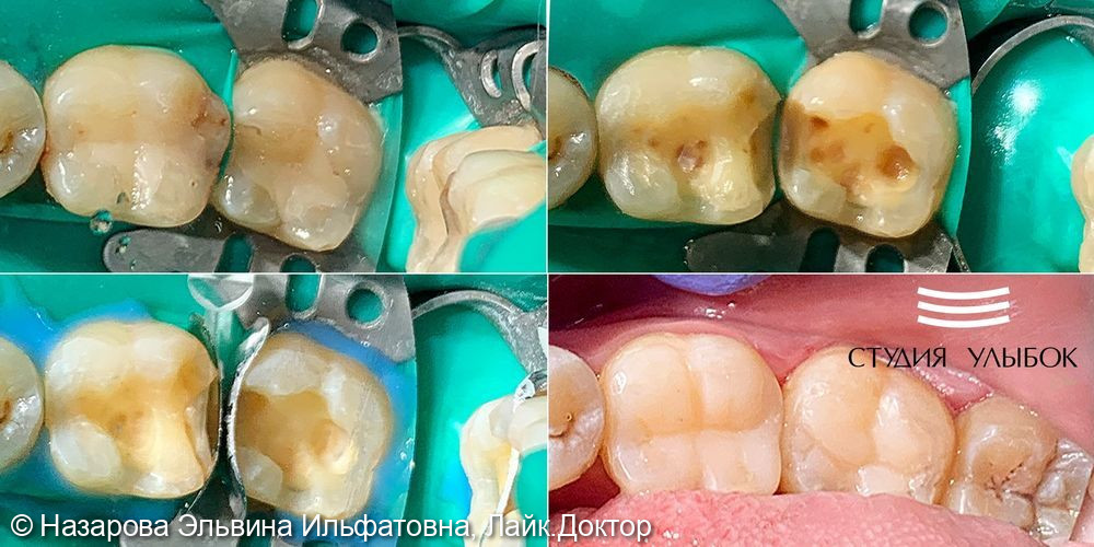 Кейс лечения среднего кариеса шестого и седьмого зуба у пациента 35-ти лет - фото №1