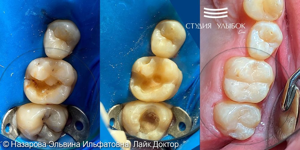 Лечение глубокого кариеса 16 и 17 зубов - фото №1