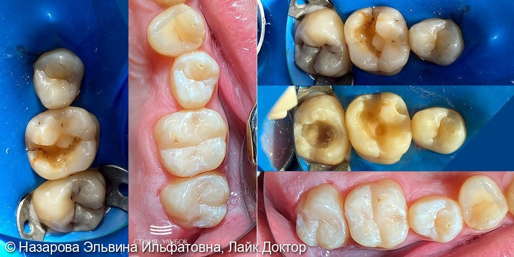 Лечение глубокого кариеса 16 и 17 зубов - фото №2