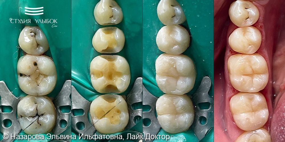 Лечение среднего кариеса 35, 36, 37 зубов - фото №1