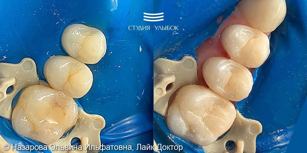Результаты лечения среднего кариеса сразу трех зубов: 14,15,16 - фото №1