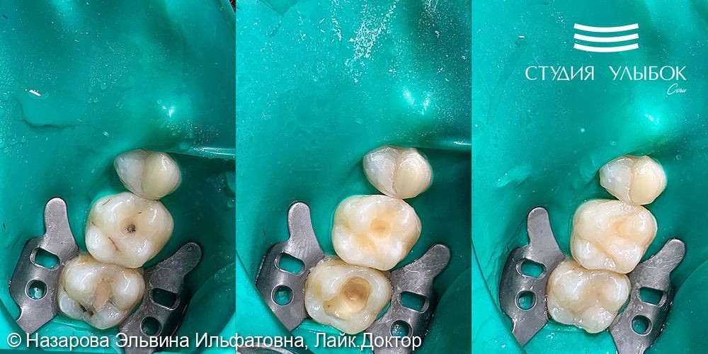 Лечение среднего кариеса 16 и 17 зубов у девушки 25-ти лет - фото №1